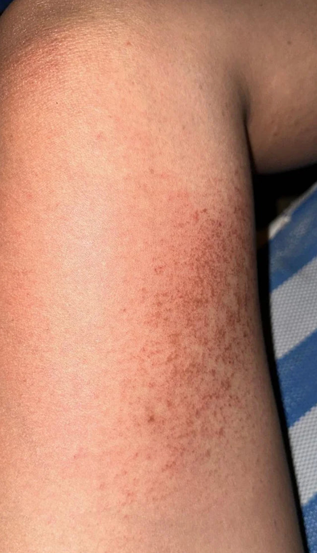 Chafing, surfers rash, wettie rash .... what is it? and what can you do to avoid it?